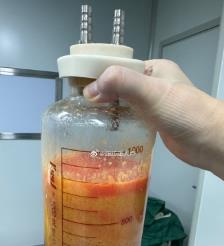 双峰水动力吸脂手术要做多久？